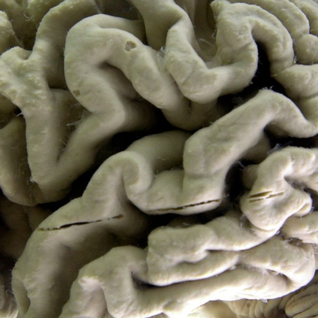 Study shows a blood test can help identify healthy people at
high risk for Alzheimer’s disease
