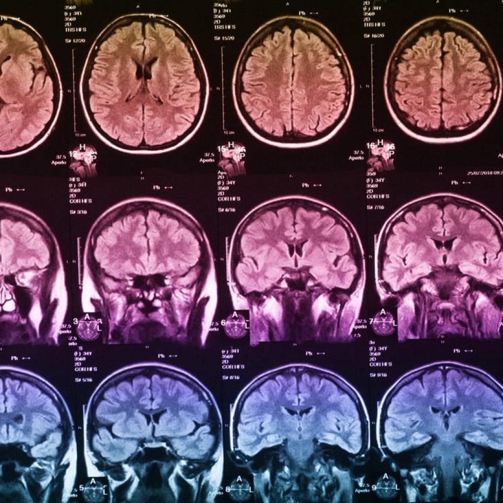 Neuroimaging study of 30,000 adults links the size of six brain areas to stronger working memory
