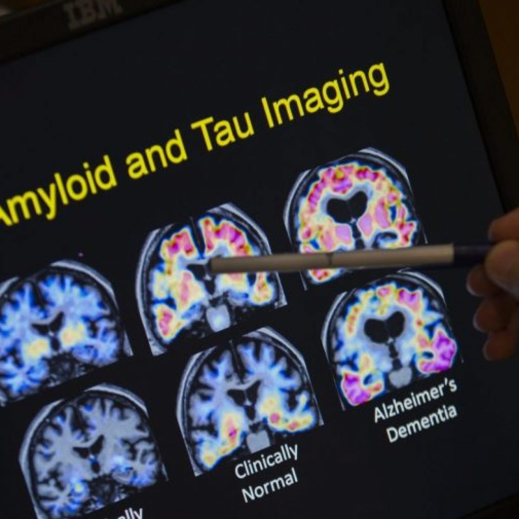 Naturally occurring human peptide shows promise against
Alzheimer’s