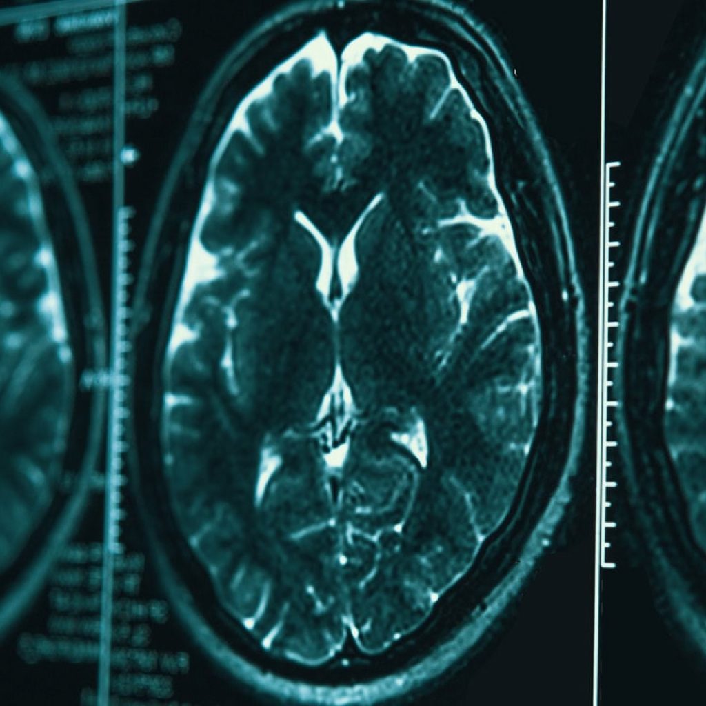 Brain structure linked to how well patients respond to an antidepressant, small study finds