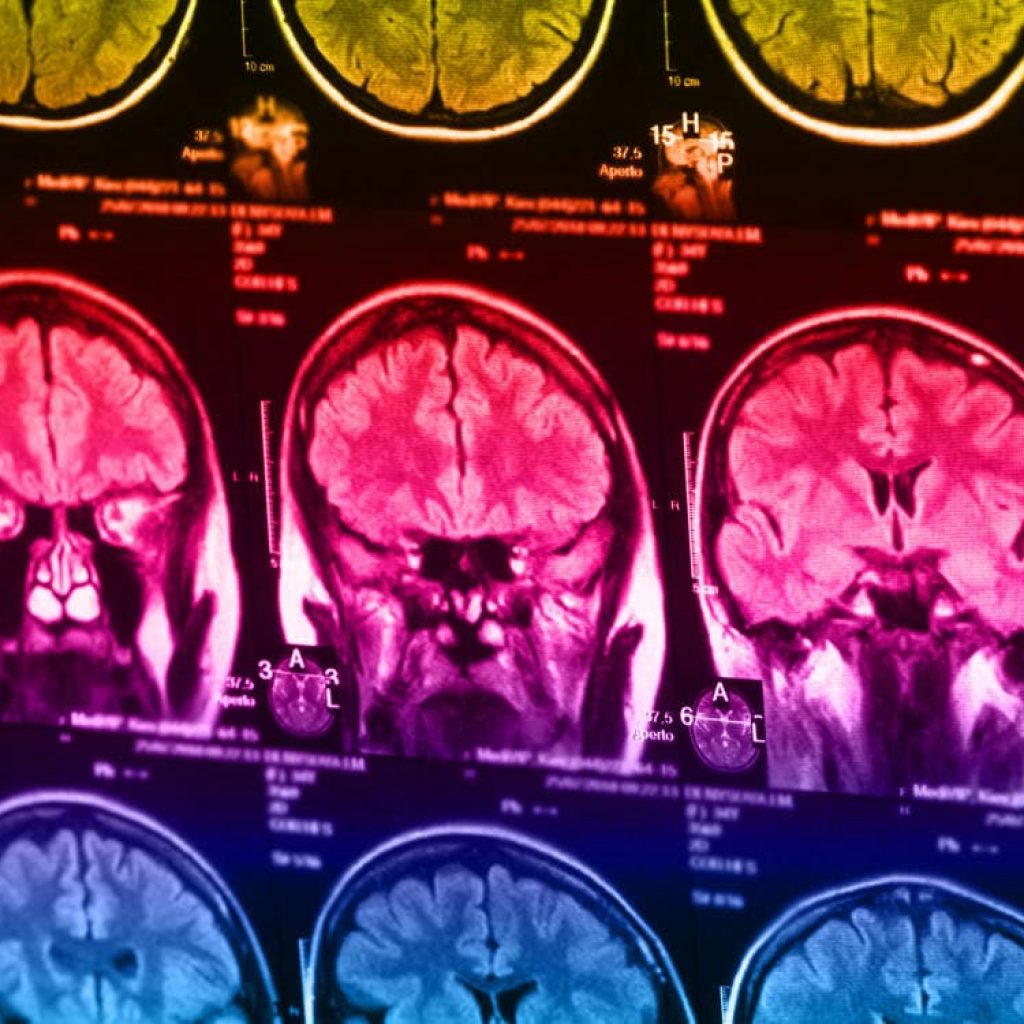 Psychological resilience may buffer children’s brains against some effects of abuse