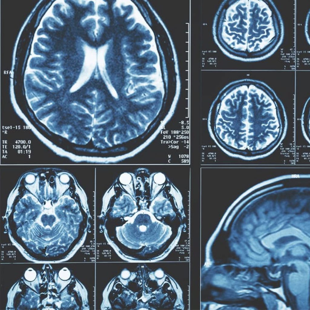 What neuroscientists thought was a biological signature for IQ might actually be socioeconomic privilege
