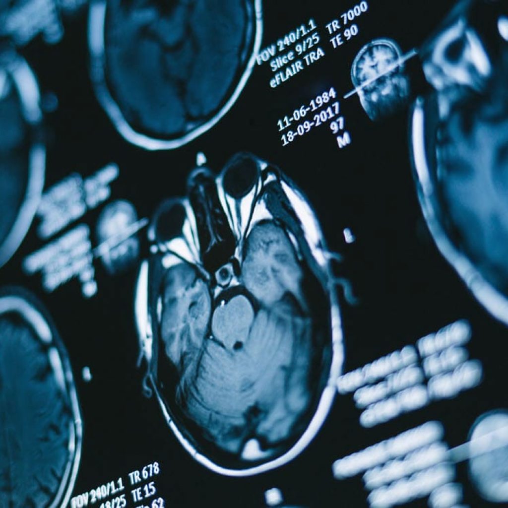 Childhood war exposure might shift the neural correlates of attachment-related anxiety and avoidance