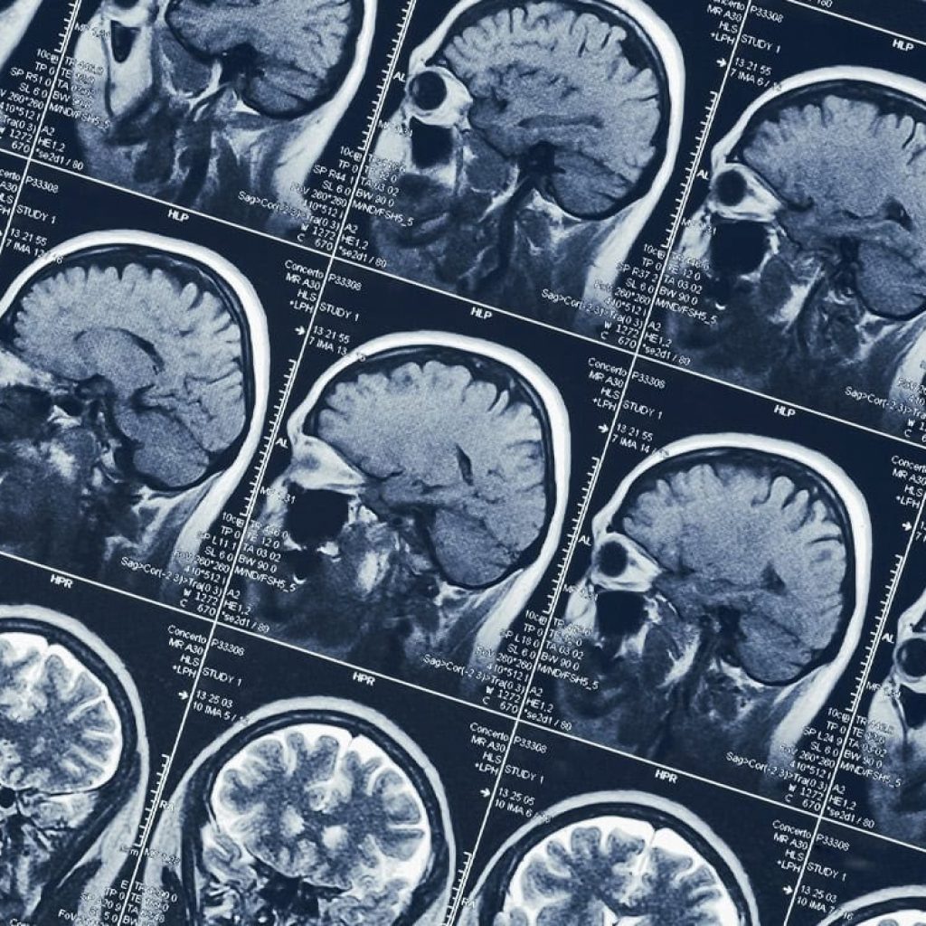 More time spent playing video games is linked to a thinner cerebral cortex in adolescents