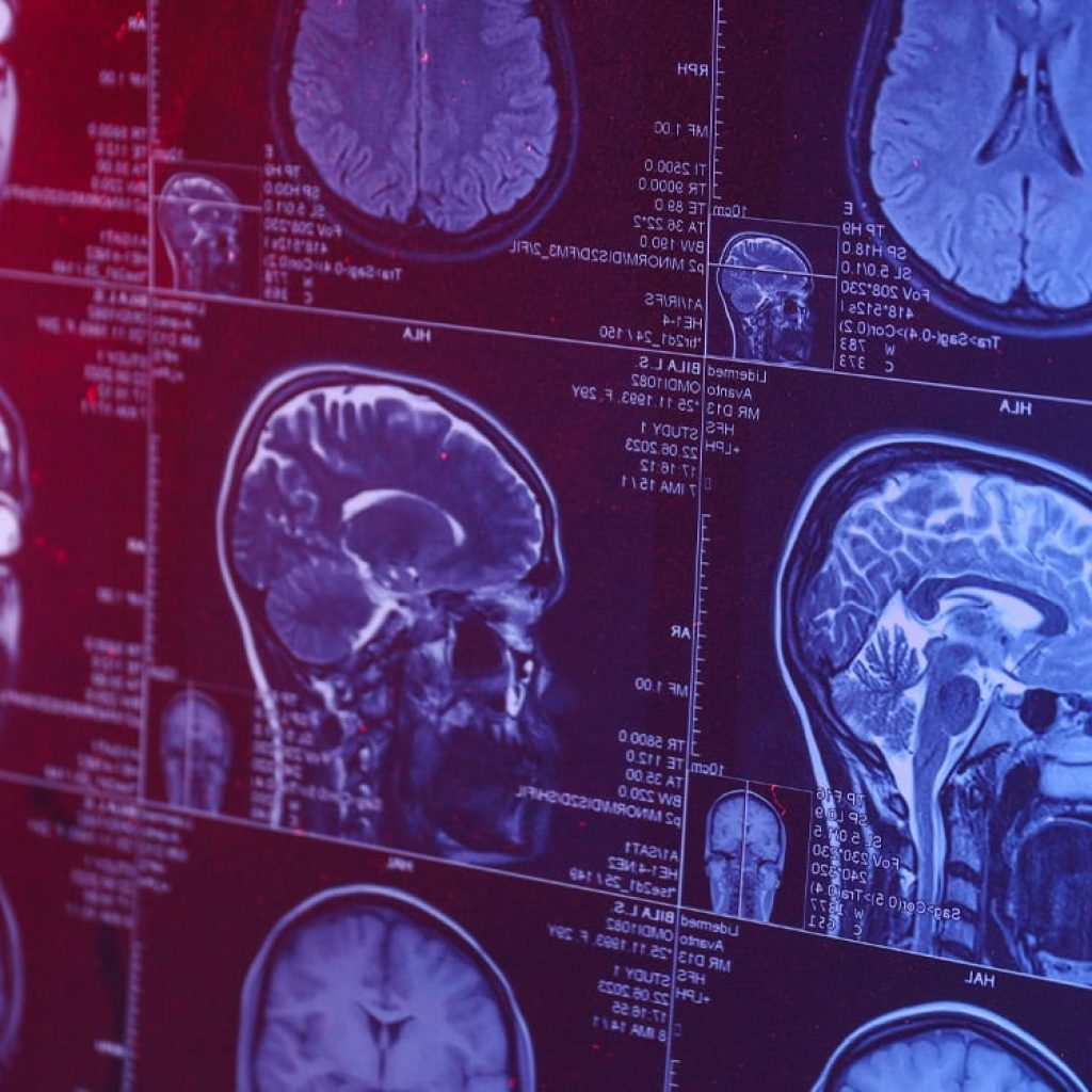 Do antidepressants actually alter brain structure? A massive neuroscience study weighs in