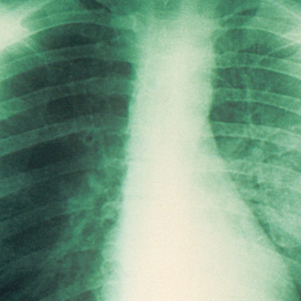 What Is Pneumonic Plague? Symptoms of the Lung
Infection