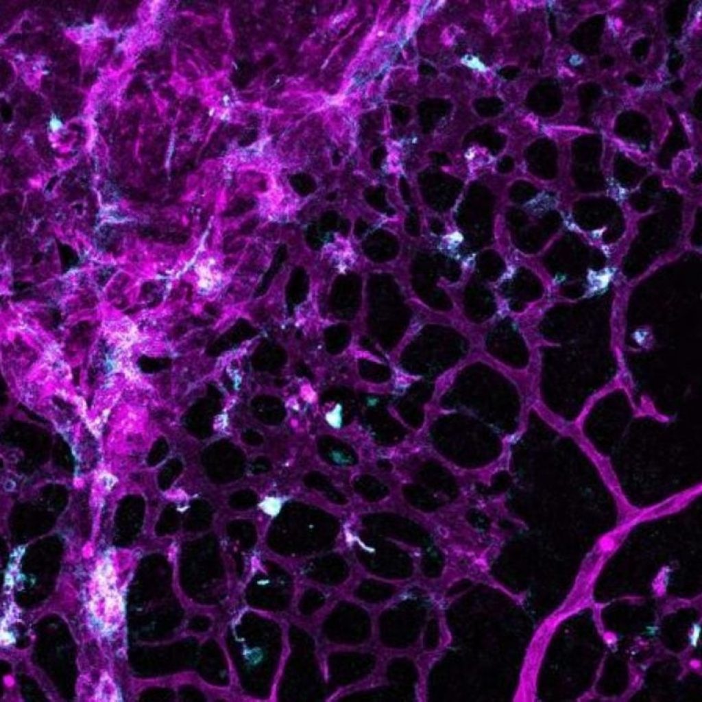 Cancer Drug Halts Fragile Brain Bleeds