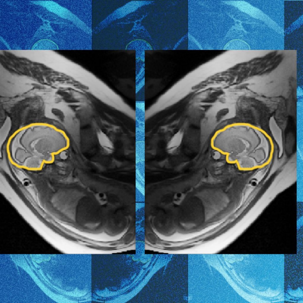 Why teaching AI about symmetry could make prenatal diagnosis
more reliable