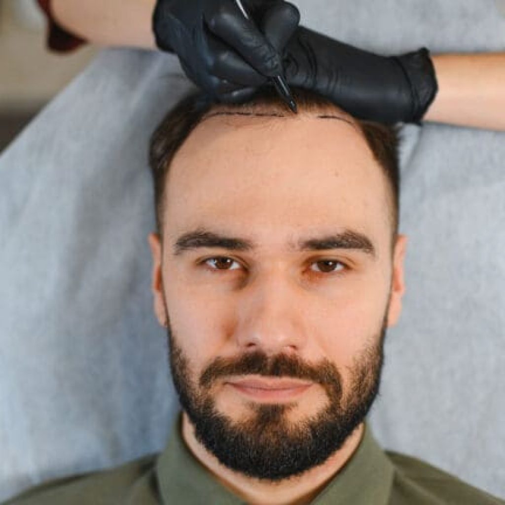Top 10 Best Hair Transplant in Turkey