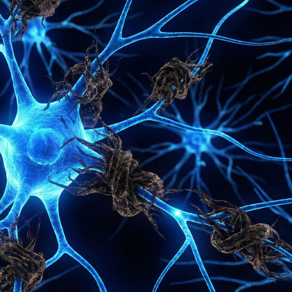 Brain scans find tau buildup in nearly two-thirds of patients with late-onset psychosis